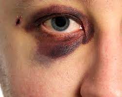 Black eye