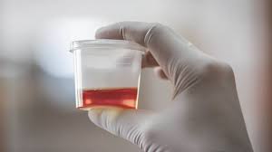 blood in urine