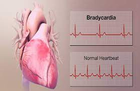 bradycardia hea