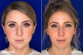 Face Surgery