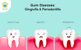 gingivitis dise