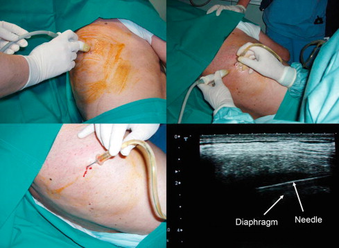 Interventional 