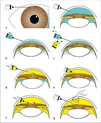 Intracameral