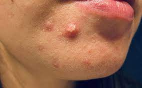 Pustules (small