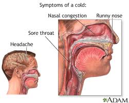 A common cold.