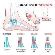 Ankle Injuries