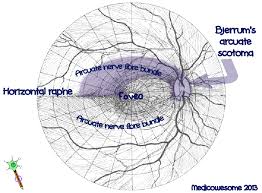 Arcuate Scotoma