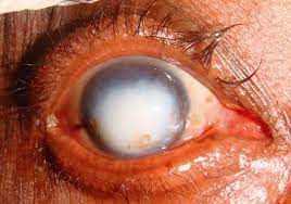 Corneal Blindness