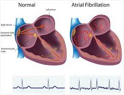 Fibrillation