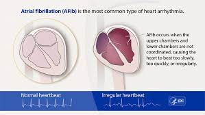 Fibrillation heartbeat