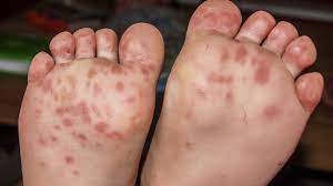 Foot And Mouth Disease