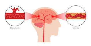 Ischemic strokes