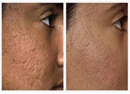 Laser skin resurfacing