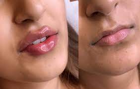 Lip augmentation