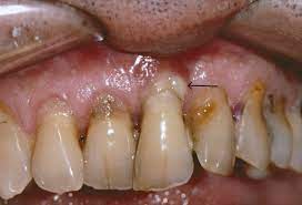 Periodontitis gum disease