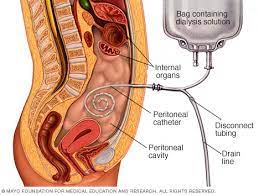 Peritoneal Dialysis