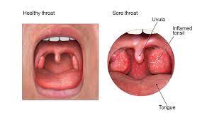 sore throat