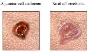 Squamous cell carcinoma