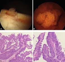 Urothelial carcinoma