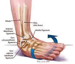 Ankle Injuries