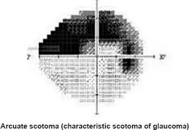 Arcuate Scotoma