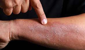 atopic dermatitis