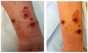 Cutaneous anthrax