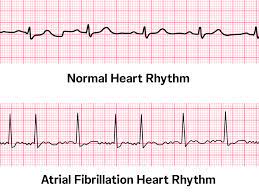 Fibrillation heartbeat