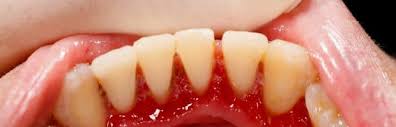 gingivitis disease