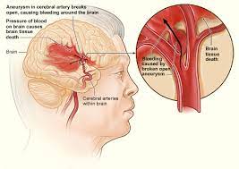 Hemorrhagic stroke