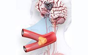 Ischemic strokes