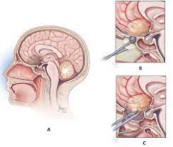 Neuroendoscopy