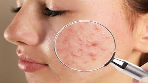 Pustules (small red bumps containing white or yell