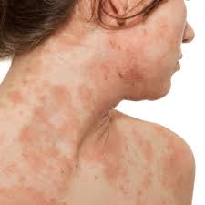 Redness around the skin eruptions