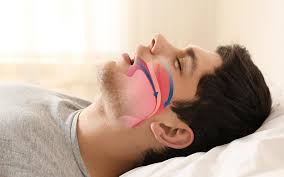 Snoring and sleep apnea