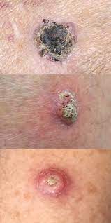 Squamous cell carcinoma