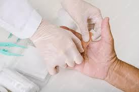 Trigger Finger Surgery in pune