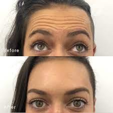 Anti-wrinkle injections