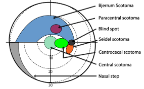 Arcuate Scotoma