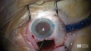 Cataracts Surgery