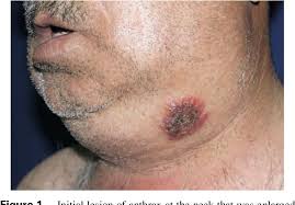 Cutaneous anthrax