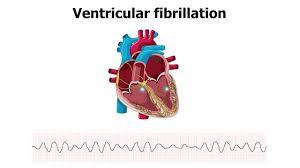 Fibrillation heartbeat