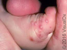 Foot And Mouth Disease