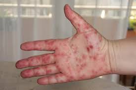 Hand foot and mouth disease