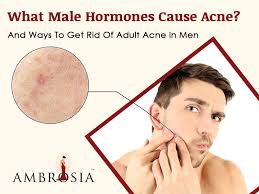 Hormonal acne