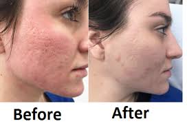 Laser skin resurfacing