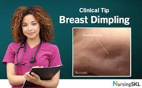 Irritation or dimpling of breast skin